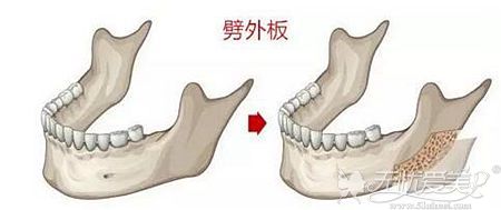 劈外板的优势和注意事项