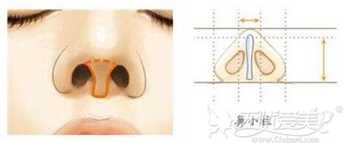 鼻综合造成的鼻小柱歪斜修复后鼻孔能达到一致吗？