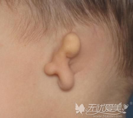 韩国普罗菲耳能矫正小耳症就一直在打听，发现BIO也能做