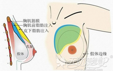 假体隆胸手术拆线后是不是需要每天都按摩？