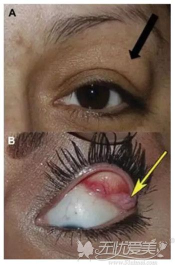 泪腺脱垂的原因和表现