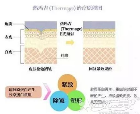 热玛吉祛颈纹原理