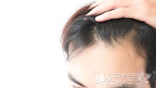 种植发际线不想用自体毛发可以选择人工纤维毛发移植