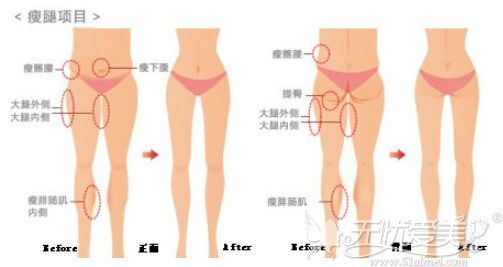 腿部吸脂抽取的位置
