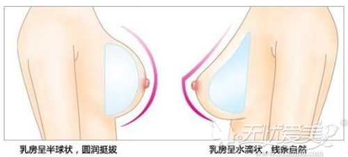 因哺乳造成的水滴胸选择哪种形状的曼托隆胸假体好看