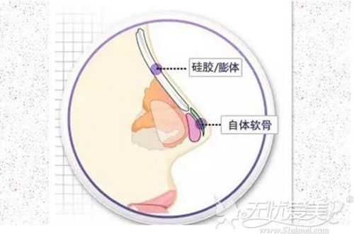 硅胶隆鼻为什么要加耳软骨的原因就是防止假体下滑