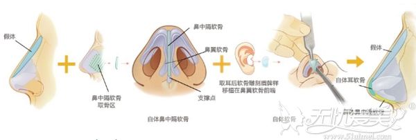 鼻综合的手术过程