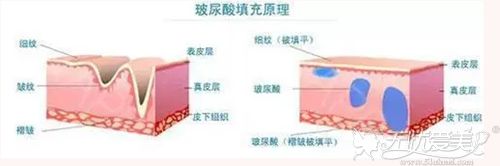 玻尿酸注射除皱的效果