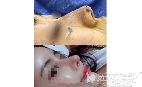 韩国topclass鼻修复案例