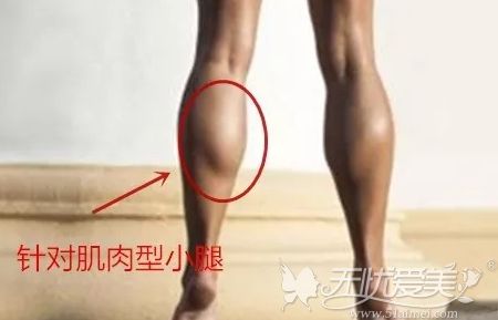 肌肉小腿可以选择小腿神阻断术
