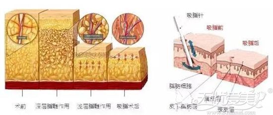 大腿吸脂手术过程