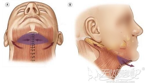 颈阔肌成形术原理