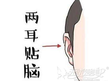 耳朵太贴脑后手术矫正方法其实就是贴发耳矫正,原理很简单