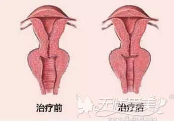 阴道紧缩手术的效果