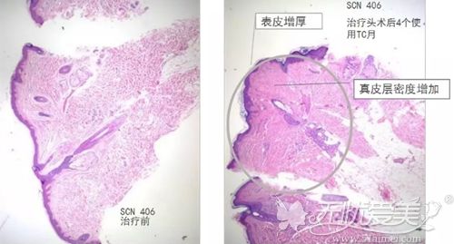 热玛吉的治疗效果