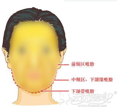 面部复合消融能做的部位