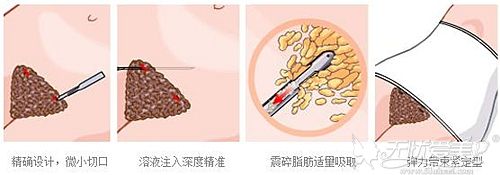 腰腹环吸手术过程