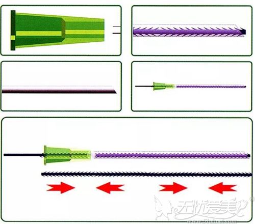 PPDO四向锯齿线