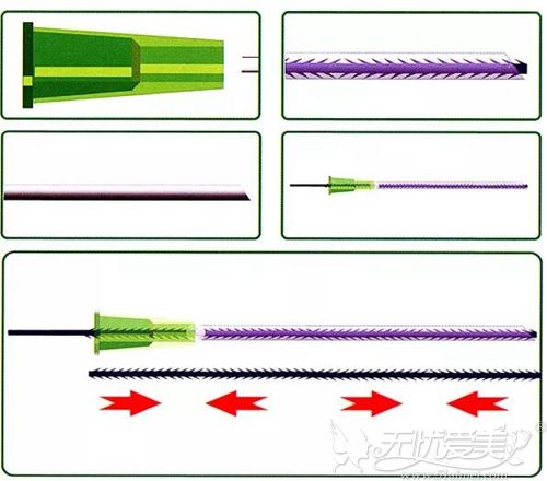 PPDO四向锯齿线