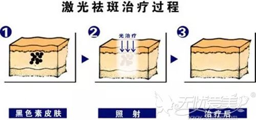 光子祛雀斑的原理