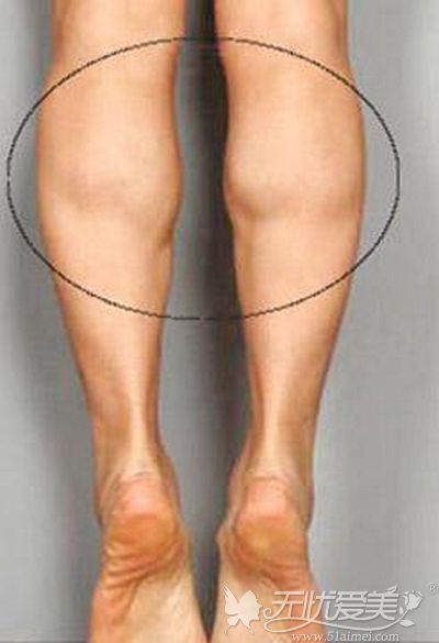 肌肉型小腿的判断方式