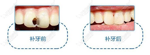 树脂补牙缝前后对比图