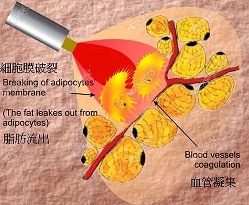 皮层光焊溶脂的优势