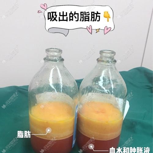 做吸脂手术抽出来的脂肪