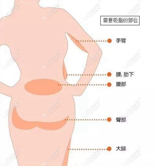 女生150斤做全身吸脂能抽多少斤？一次能瘦个20斤吗？