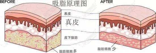 吸脂手术的层次