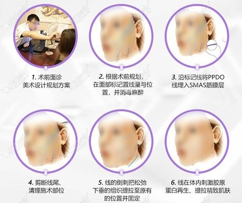埋线提升的切口位置