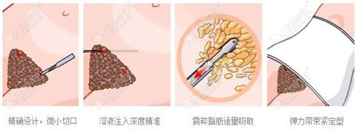 腰腹环吸手术过程