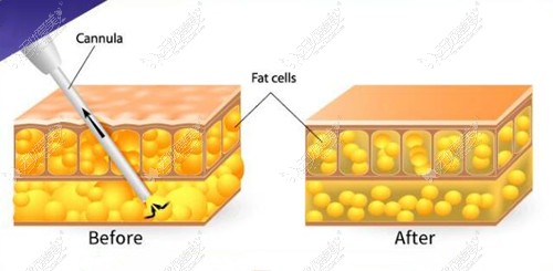 腰腹抽脂手术后脂肪细胞变化