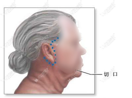 拉皮手术耳前切口位置