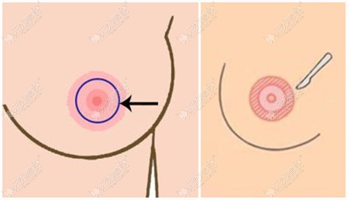 乳房双环术疤痕图片