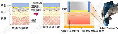 热玛吉可达到的层次