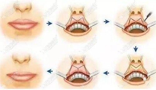 M唇手术的原理图