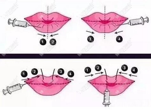 M唇修复手术的方法