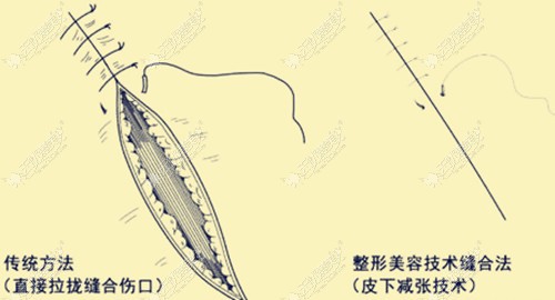 M唇手术的正确缝合方法