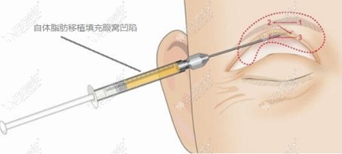 眼窝凹陷做脂肪填充