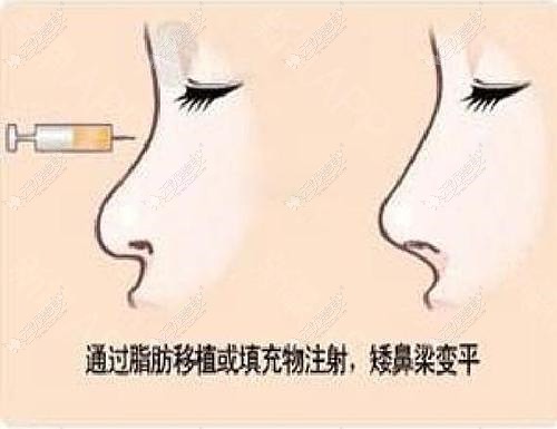 自体脂肪隆鼻后效果对比