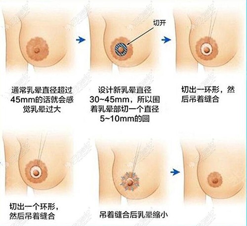 乳晕切口缩小过程