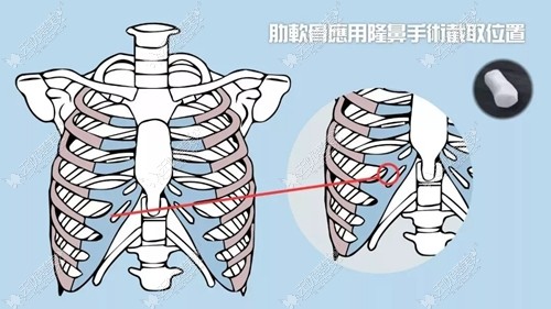 肋软骨隆鼻取肋骨的部分