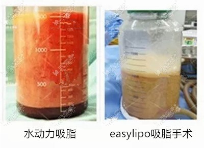 easylipo和水动力吸脂对比