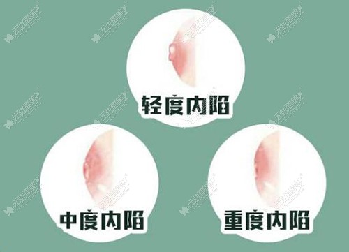 乳头凹陷的分类