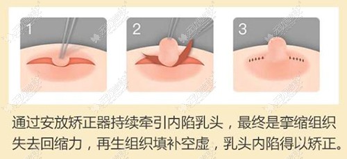 乳头内陷矫正方法