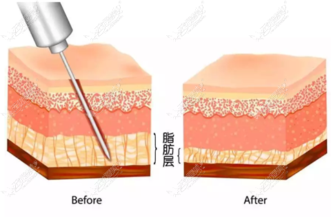 吸脂去除富贵包手术过程