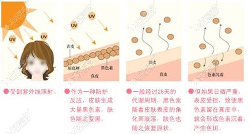 激光祛斑后注意防晒