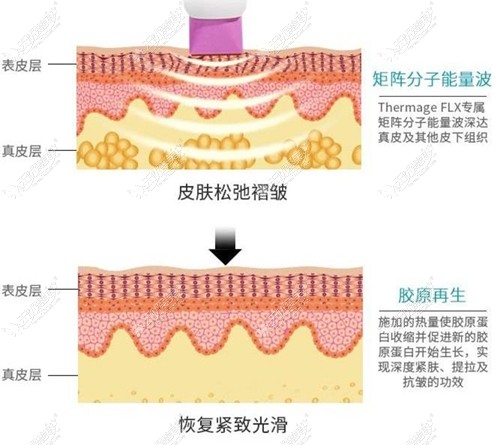 热玛吉的治疗原理