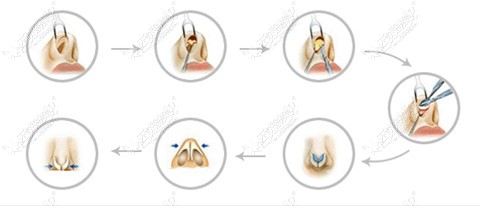 隆鼻手术过程